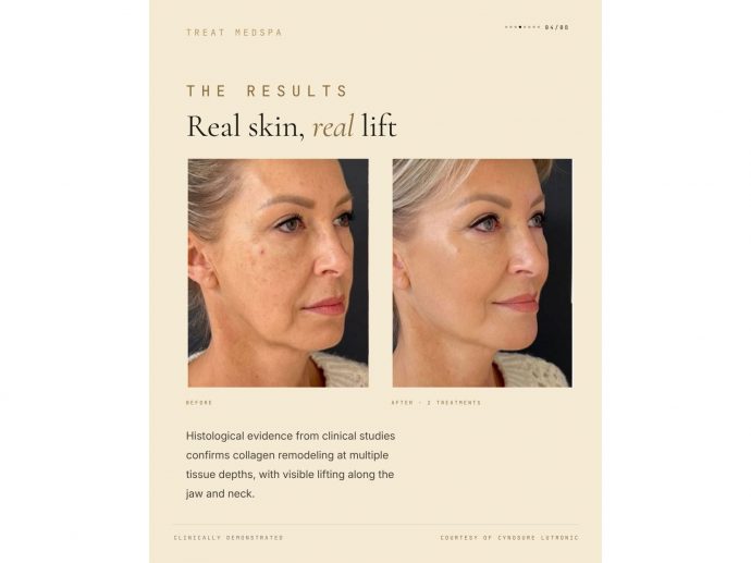 TREAT Medspa Introduces EMFACE Eyes, Elevating Under-Eye Rejuvenation with a Needle-Free Approach