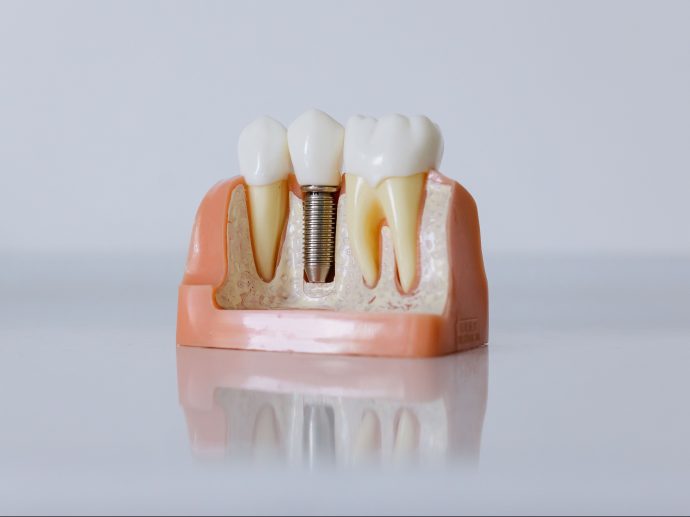 Transforming Smiles in Thayer, Missouri: The Lasting Impact of Dental Implants