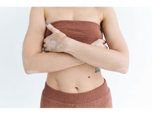 How To Deal With Pigmentation And Potential Treatments