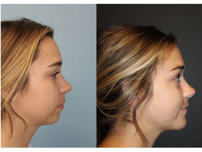 Chicagoland's Renowned Warner Institute Unveils New "SWIFT Sculpt" Procedure