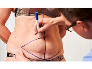 Tummy Tuck: What Worries Patients Most