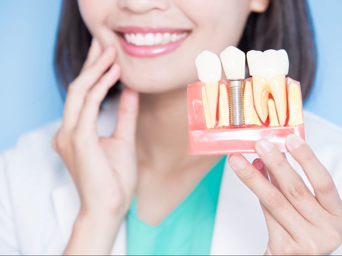 How Long Does It Take To Do A Tooth Implant? 