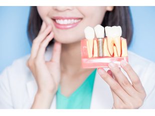 How Long Does It Take To Get All-On-4 Dental Implants? 