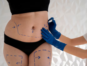 Venus Bliss vs. CoolSculpting: Which Fat Reduction Treatment Is Right for You?