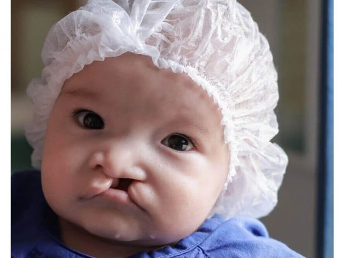 Smile Train Launches Africa's Largest Cleft Center in Ghana