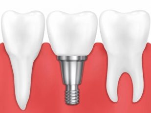Discover the Benefits of All-on-4 Dental Implants